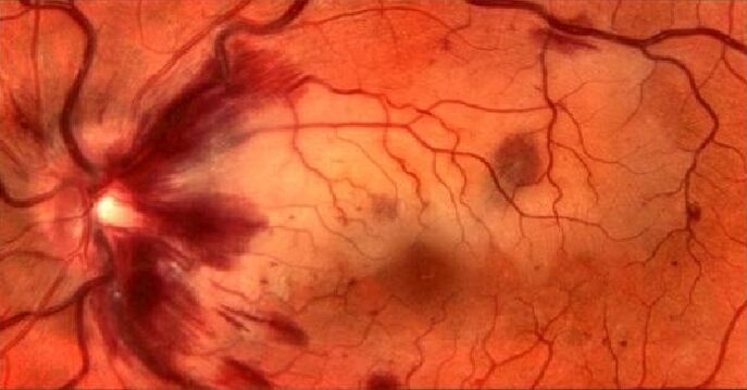Retinanın kan damarları ve görme restorasyonu